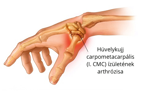 A kéz- és csuklóízületi gyulladás - leírása, kezelése